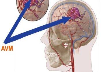 What is AVM Full Form?