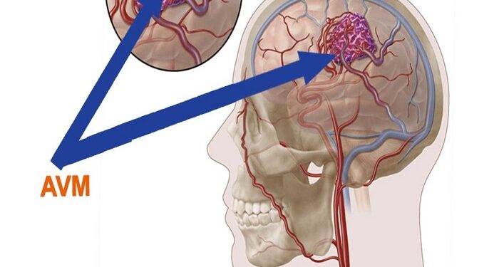 What is AVM Full Form?